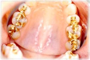 مزايا و معایب مصرف طلا در دندانپزشکی